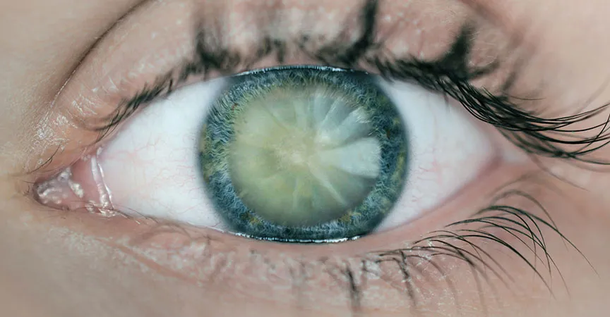 cataracts.jpg